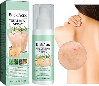 Back Acne Treatment Spray, Body Acne Spray Gentle Acne Oil Control Redness Smooth Skin Cleans Pores Moisturizes Easy to Use and Quick Dry Formula,Gentle on Skin, Care for Chest & Butt Acne