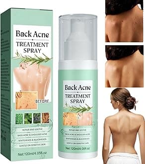 Acne Treatment Spray for Back & Body - 120ml